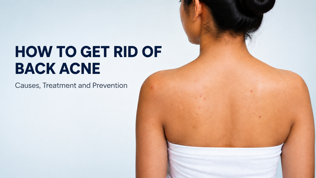 Indian woman with mild back acne and post-acne marks, illustrating the causes, treatment and prevention of back acne.