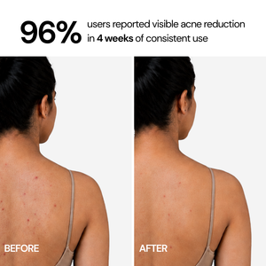 Acne Control Body Wash