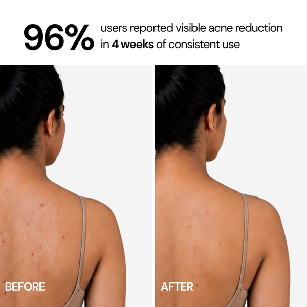 Acne Control Body Wash