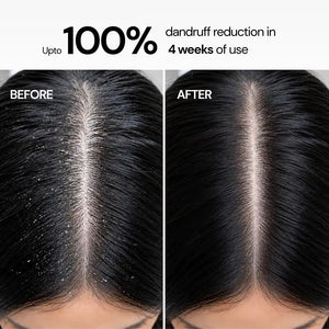 Anti-Dandruff Flake Control Conditioning Shampoo with 2% Zinc Pyrithione & 1% Piroctone Olamine - 200 ml