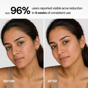 Acne Control Oil Balancing Serum Face Wash