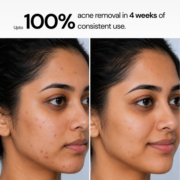 Anti Acne Soap - Pack of 4