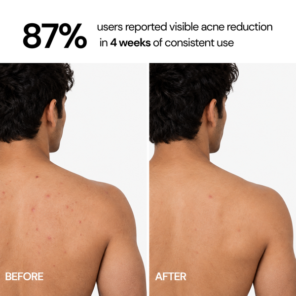 Acne Control Body Wash with 1% Salicylic Acid & 2% Niacinamide - 400 ml