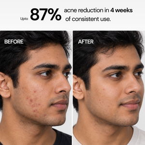Anti Acne Soap with 1% Salicylic Acid & 0.5% Activated Charcoal | Pack of 4