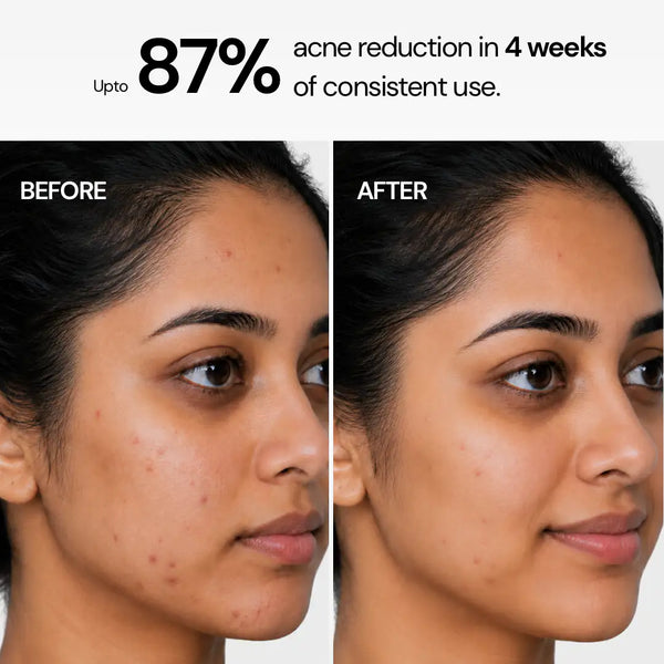 Anti Acne Soap with 1% Salicylic Acid & 0.5% Activated Charcoal | Pack of 4