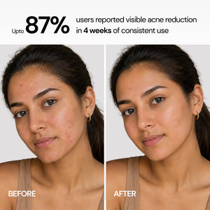 Acne Control Face Wash with 2% Salicylic Acid & 2% Niacinamide - 200 ml