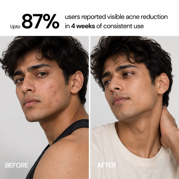 Acne Control Face Wash | 200 ml