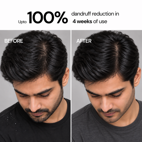 Anti-Dandruff Flake Control Conditioning Shampoo with 2% Zinc Pyrithione & 1% Piroctone Olamine - 200 ml